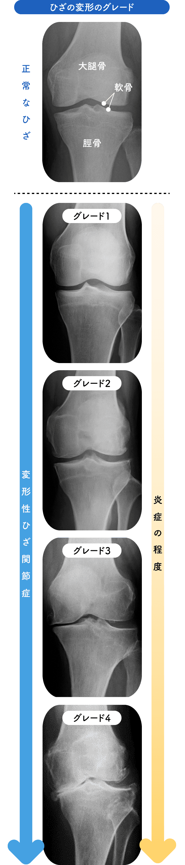 正常なひざからグレード1〜4まで、変形性ひざ関節症の進行と炎症の程度を示したレントゲン比較図