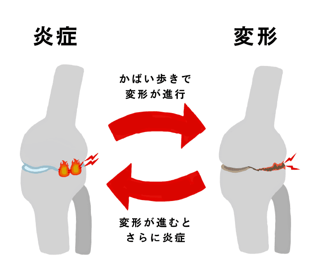 炎症と変形が互いに悪化し合う悪循環を示したイラスト。かばり歩きで変形が進み、変形が進むとさらに炎症が起きる